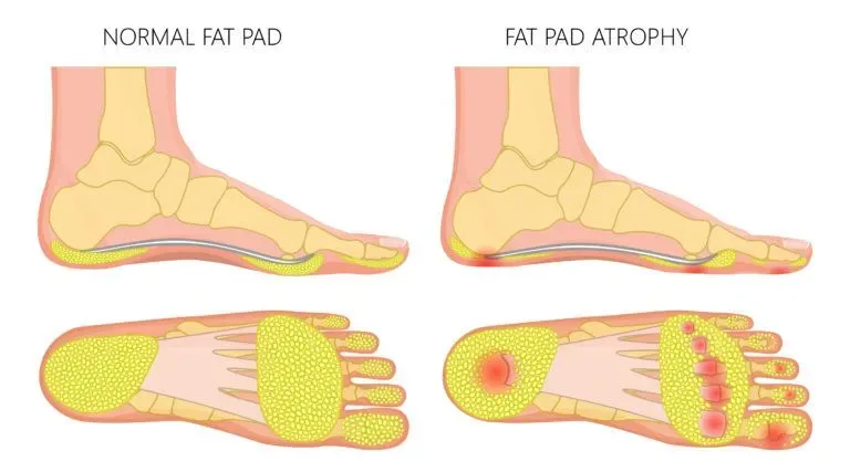 best shoe inserts for fat pad atrophy